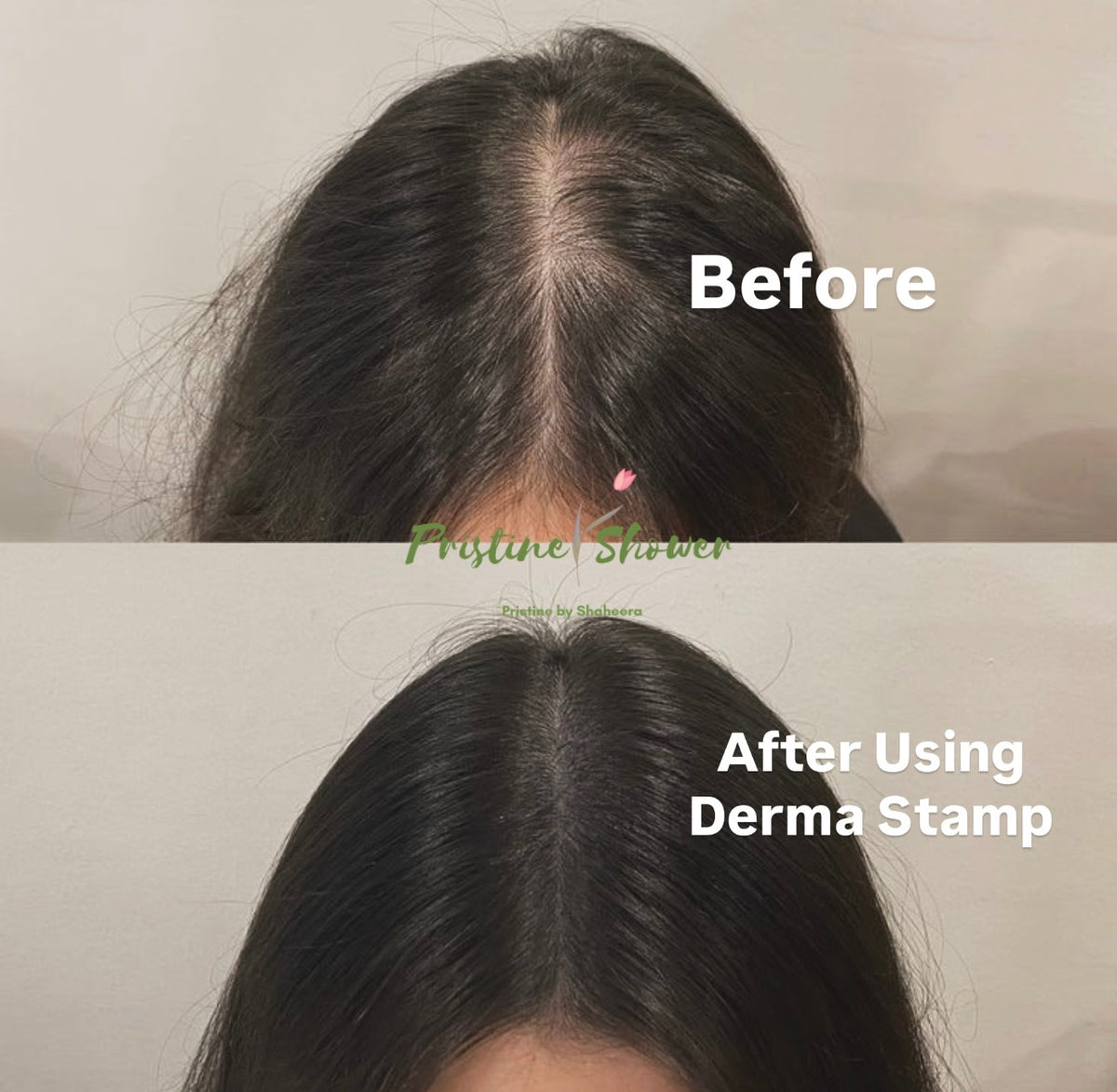 Derma Stamp for Scalp Absorption & Follicle Activation