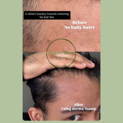 Derma Stamp for Scalp Absorption & Follicle Activation