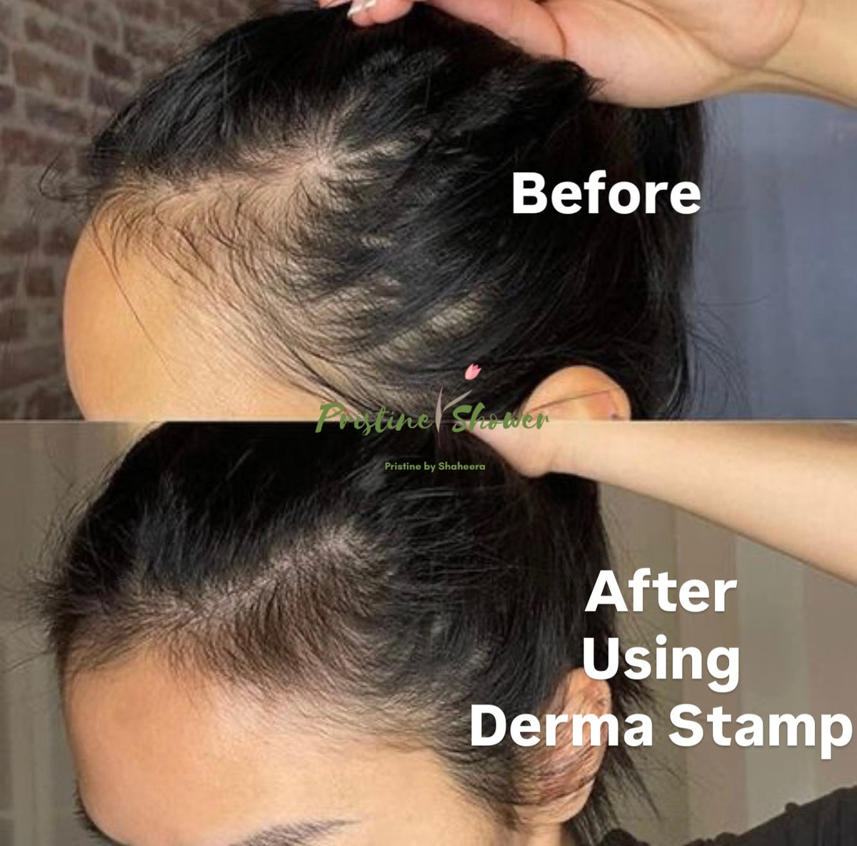 Derma Stamp for Scalp Absorption & Follicle Activation